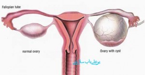 درمان کیست تخمدان